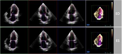 Left Heart Chamber Volumetric Assessment by Automated Three-Dimensional Echocardiography in Heart Transplant Recipients